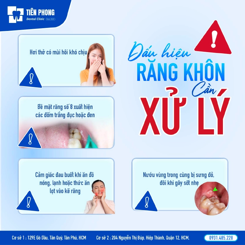Những dấu hiệu cho biết răng khôn cần được xử lý Những dấu hiệu cho biết răng khôn cần được xử lý