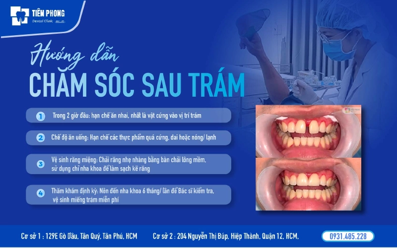 Lưu ý chăm sóc sau khi trám răng
