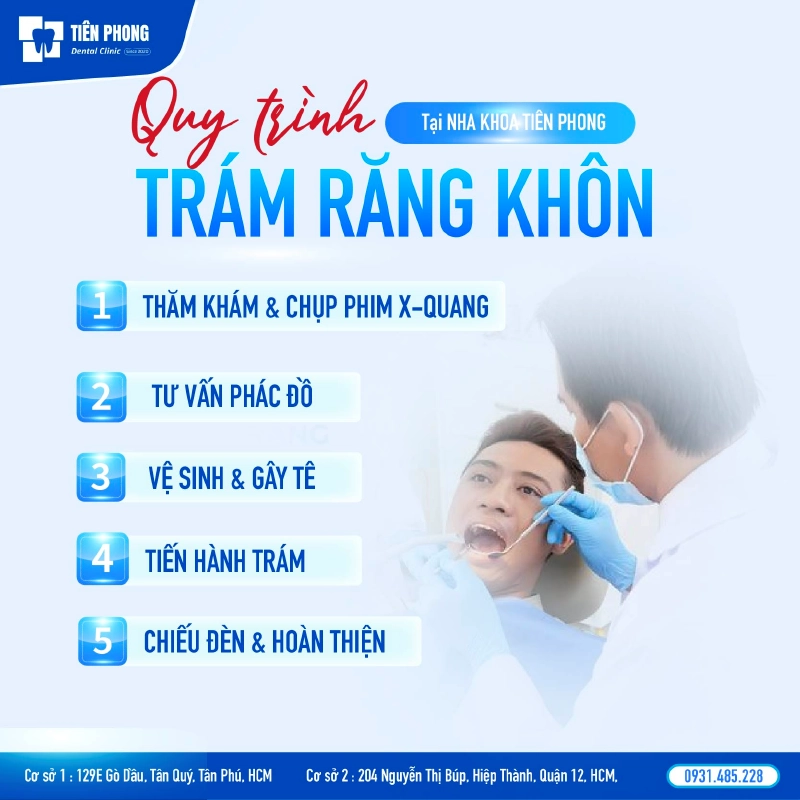 Quy trình trám răng khôn Quy trình trám răng khôn
