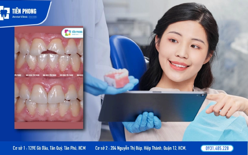 Thời điểm lý tưởng để trám răng là sau 2 3 ngày kết thúc kinh nguyệt 