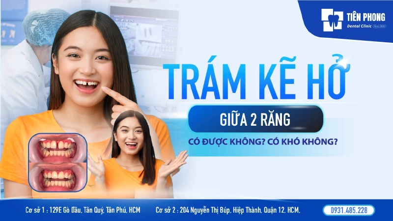 Trám kẽ hở giữa 2 răng – Giải pháp thẩm mỹ nhanh chóng và tiết kiệm