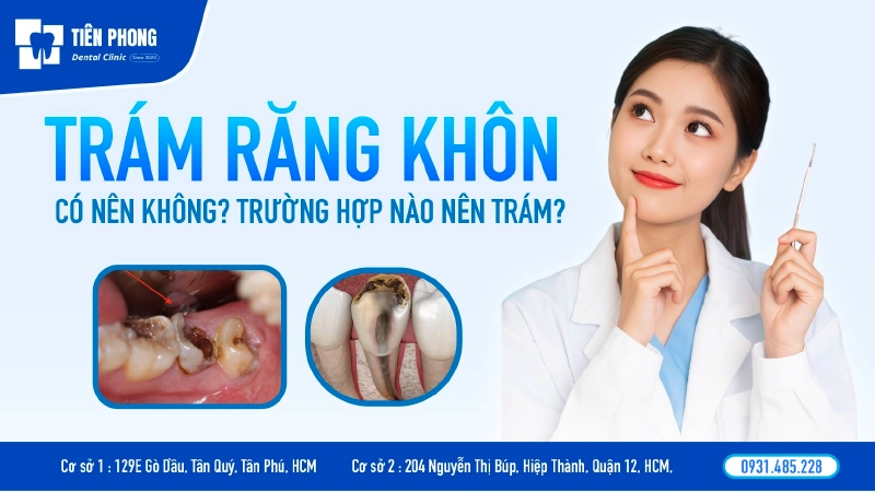 Trám răng khôn có được không? Chi phí và quy trình chuẩn Y khoa