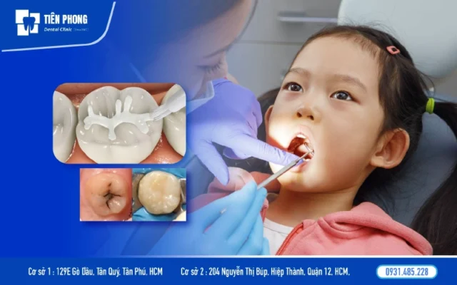 Trám răng phòng ngừa