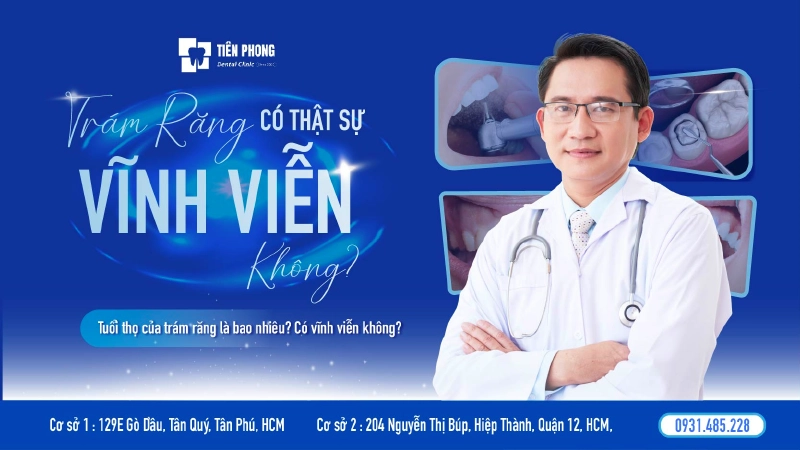 Trám răng vĩnh viễn