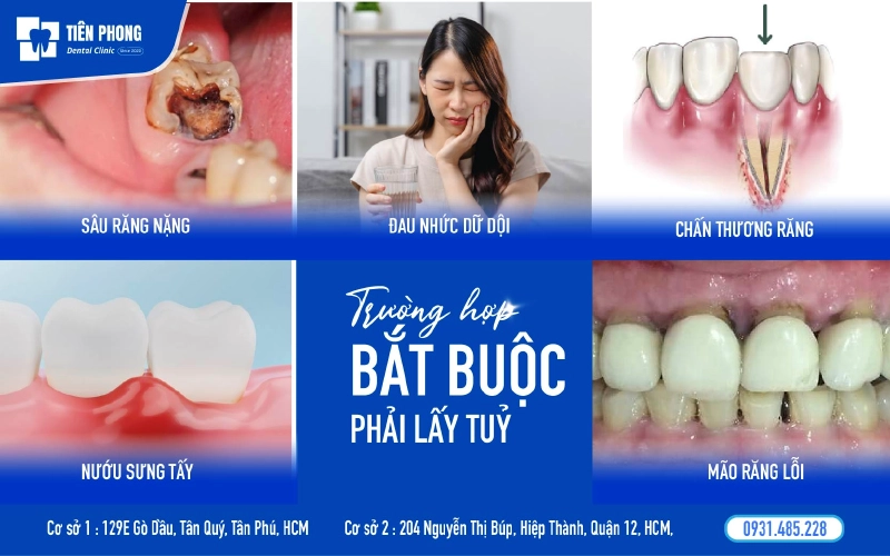 Các trường hợp bắt buộc lấy tủy răng Các trường hợp bắt buộc lấy tủy răng