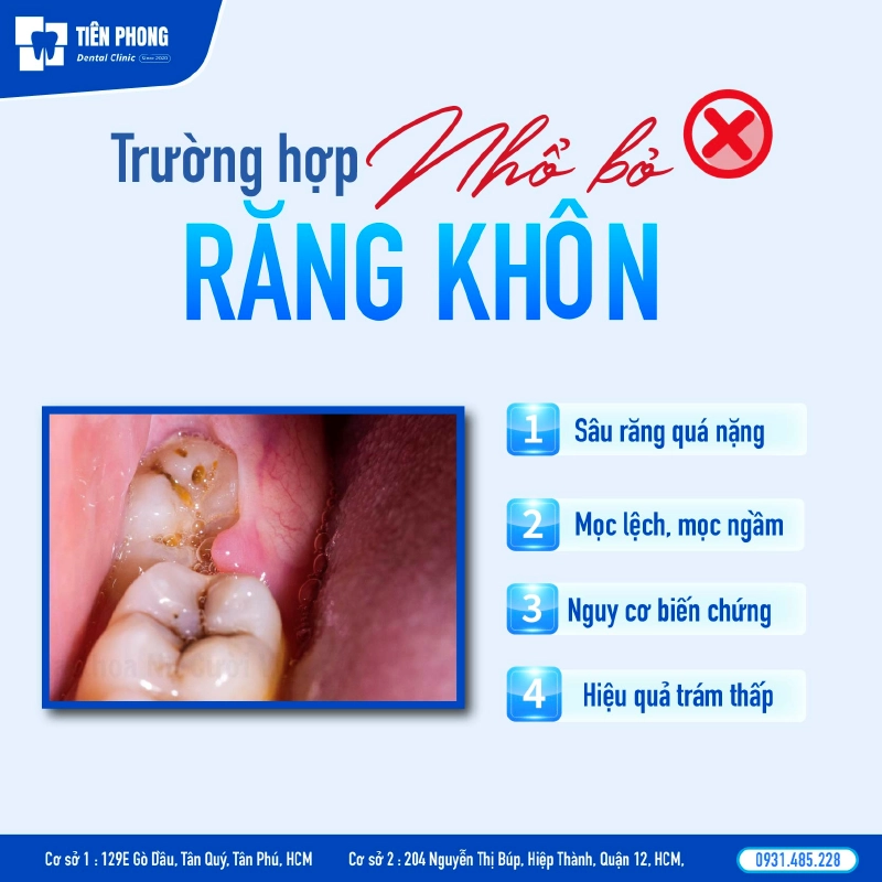 Trường hợp nên nhổ bỏ răng khôn Trường hợp nên nhổ bỏ răng khôn