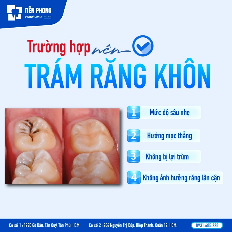Trường hợp nên trám răng khôn Trường hợp nên trám răng khôn