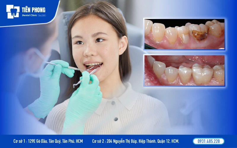 hàn trám răng là gì