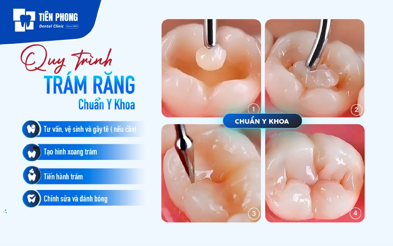Một quy trình trám răng chuẩn Y khoa bao gồm các bước