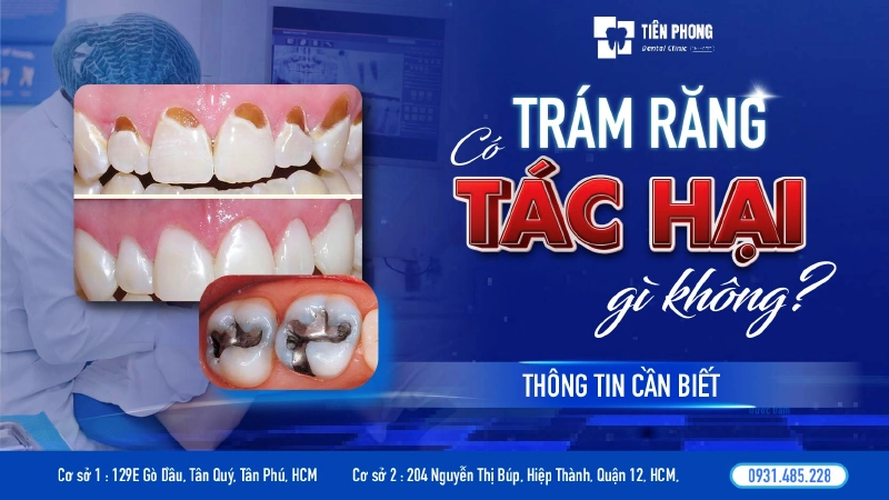 Có tác hại của việc trám răng không? Sự thật, biến chứng và cách phòng tránh