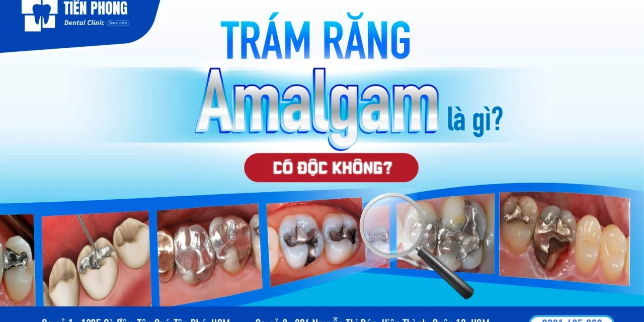 Trám răng amalgam là gì? Sự thật về trám răng chì màu xám