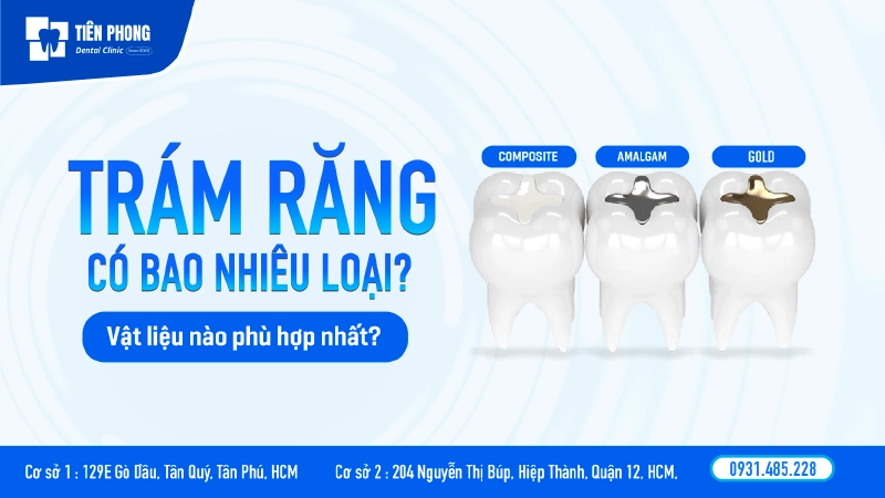 Các loại trám răng phổ biến nhất hiện nay và bảng giá chi tiết