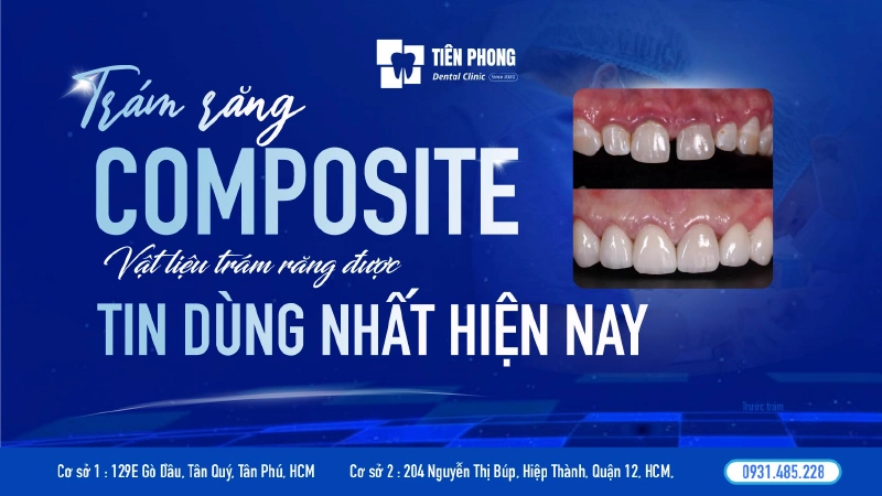 Trám răng composite – Giải pháp thẩm mỹ toàn diện cho nụ cười