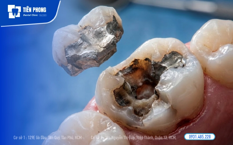 Trám răng cũ bị rơi rớt