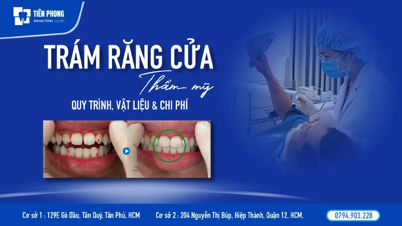 Trám răng cửa thẩm mỹ – Phục hồi răng cửa nhanh, đẹp