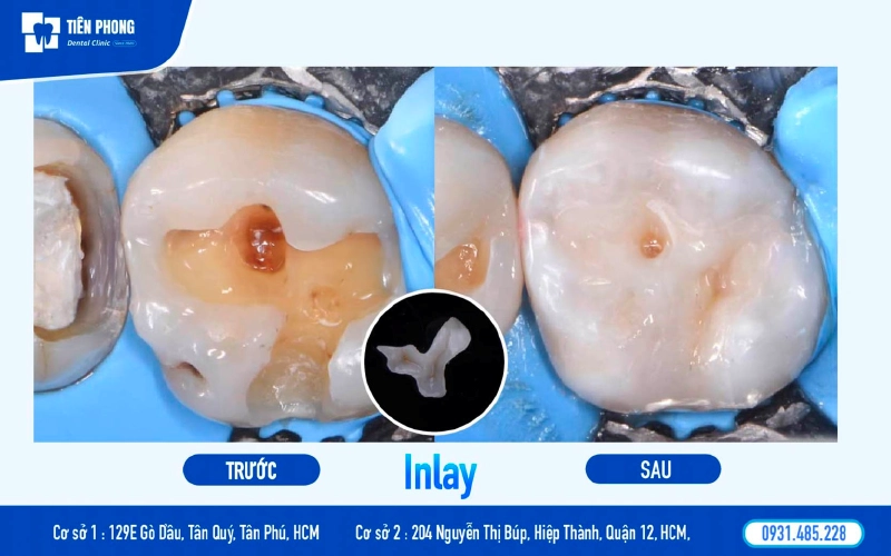 Trám sứ Inlay/Onlay có độ bền cực cao nhưng chi phí rất cao