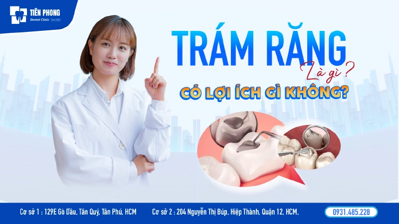Trám răng là gì? Quy trình và bảng giá chuẩn Y khoa 2026