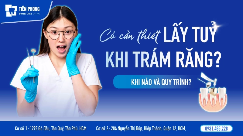 Khi nào nên Trám răng lấy tủy và những điều cần biết