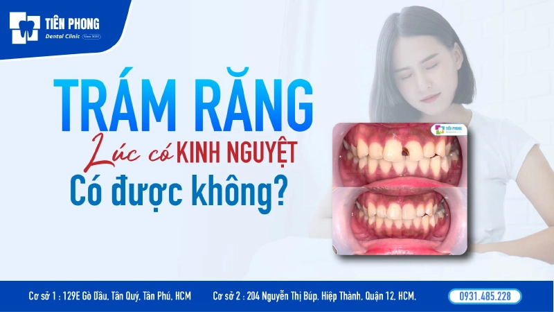 Trám răng lúc có kinh nguyệt được không? Lời khuyên từ chuyên gia