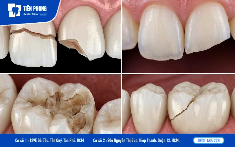 Răng mẻ vỡ là trường hợp nên trám răng