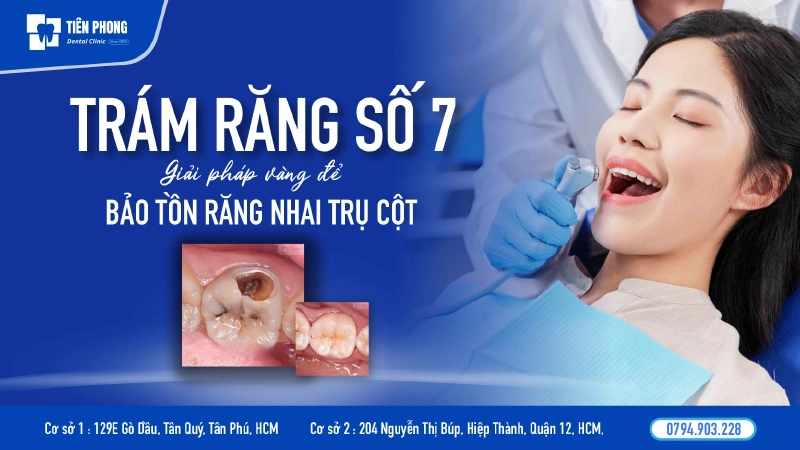 Trám răng số 7 – Giải pháp vàng để bảo tồn “trụ cột” ăn nhai