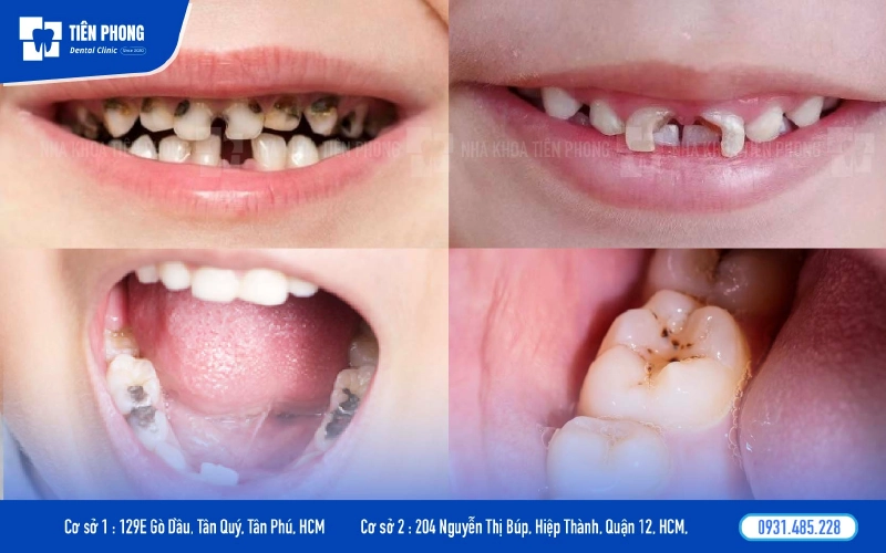 Trám răng cho trẻ em là cần thiết để bảo vệ sự phát triển tốt cho răng Trám răng cho trẻ em là cần thiết