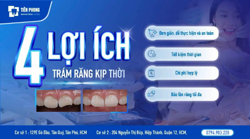 Lợi ích khi trám răng kịp thời Lợi ích khi trám răng kịp thời