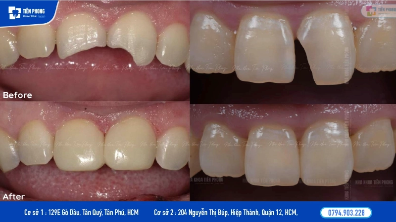 Răng gãy có trám được không phụ thuộc diện tích phần răng đã mất Răng gãy có trám được không phụ thuộc diện tích phần răng đã mất