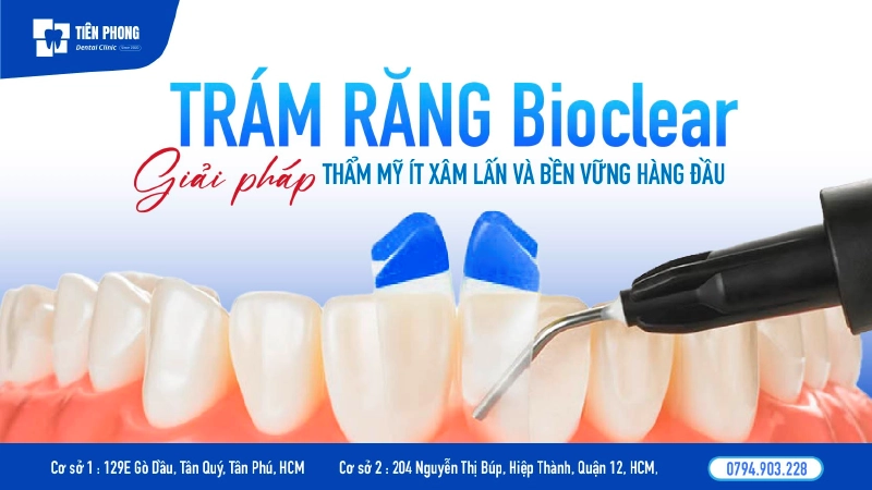 Trám răng Bioclear là gì? Công nghệ trẻ hóa cho nụ cười hiện đại
