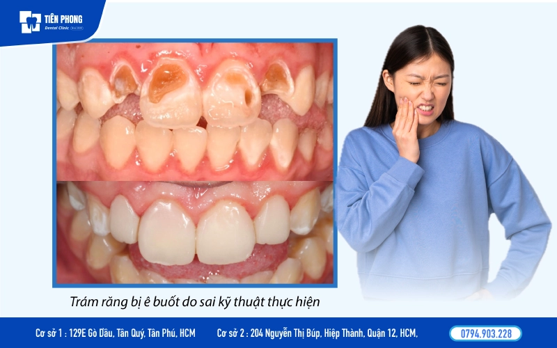Trám răng bị ê buốt do sai kỹ thuật thực hiện Trám răng bị ê buốt do sai kỹ thuật thực hiện
