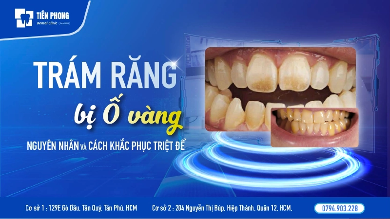 Trám răng bị ố vàng – Nguyên nhân và cách khắc phục triệt để