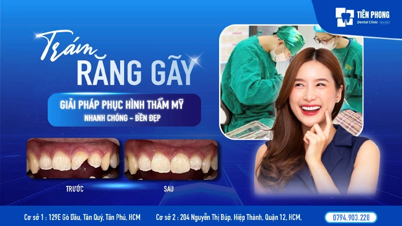 Trám răng gãy có được không? Giải pháp nhanh chóng và bền đẹp