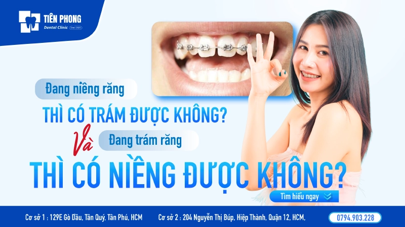 Trám răng rồi có niềng được không? Giải đáp từ Nha khoa Tiên Phong