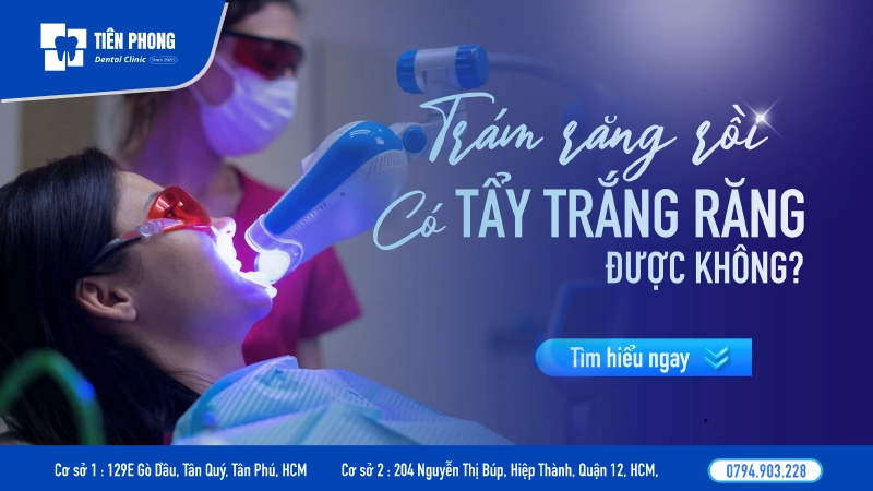 Trám răng rồi có tẩy trắng được không? Giải đáp từ nha sĩ