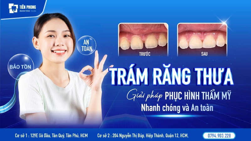 Trám răng thưa – Giải pháp phục hình thẩm mỹ nhanh chóng và an toàn