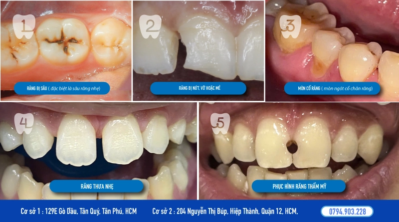 Trường hợp nên chọn trám răng Trường hợp nên chọn trám răng