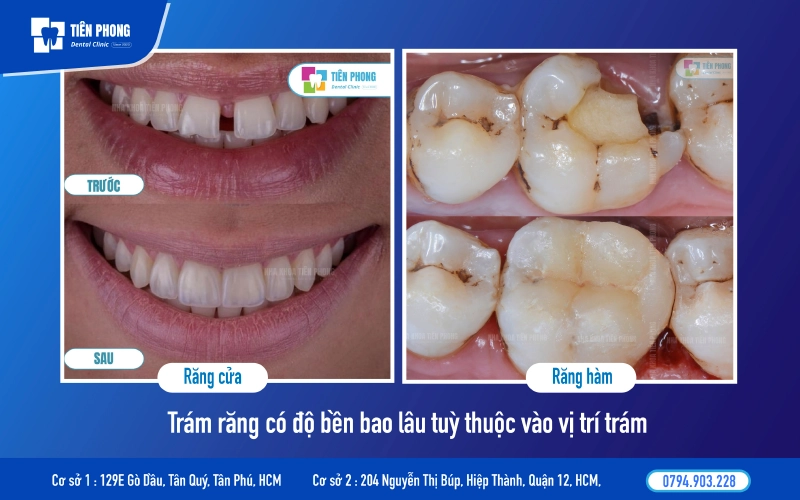 Độ bền trám răng tùy thuộc vị trí trám Độ bền trám răng tùy thuộc vị trí trám
