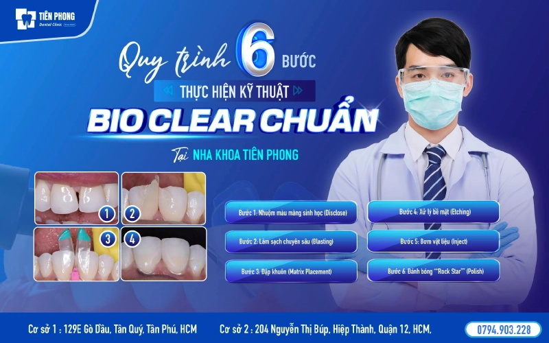 Kỹ thuật BioClear được áp dụng khi trám răng tại nha khoa Tiên Phong