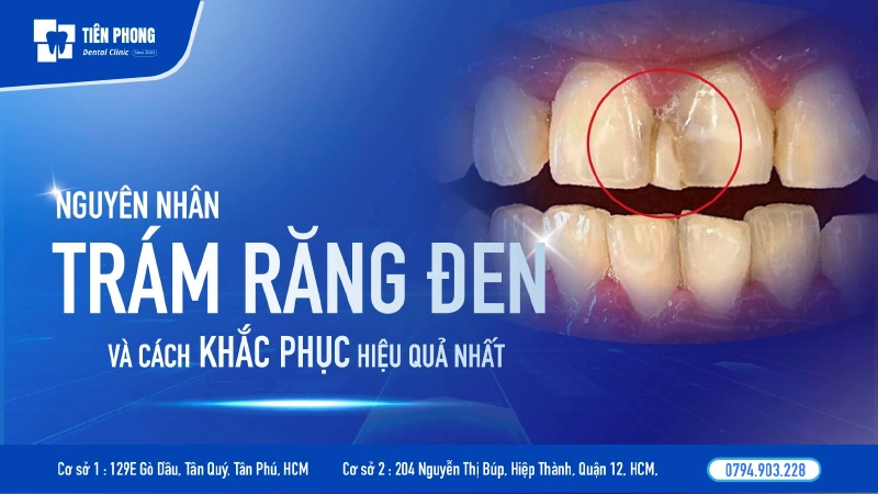 Trám răng đen – Nguyên nhân, dấu hiệu và giải pháp khắc phục triệt để