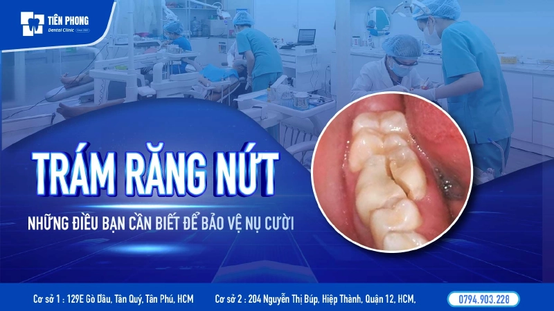 Trám răng nứt – Giải pháp phục hồi hiệu quả và bảng giá mới nhất 2026