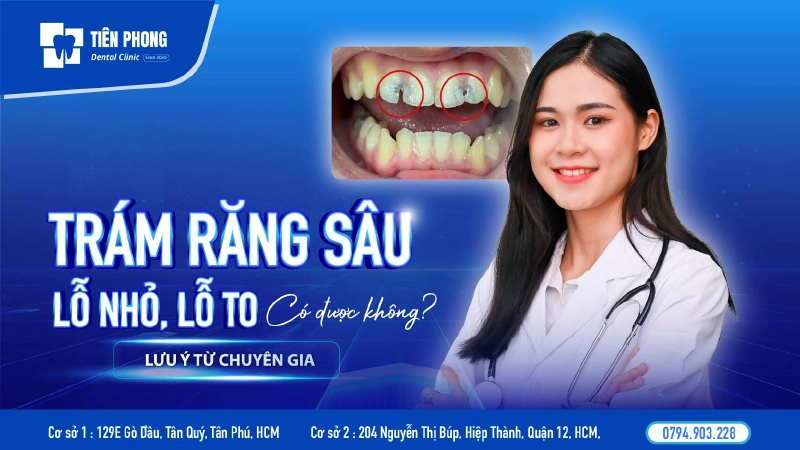 Trám răng sâu lỗ nhỏ, lỗ to có được không? Quy trình, chi phí và lưu ý