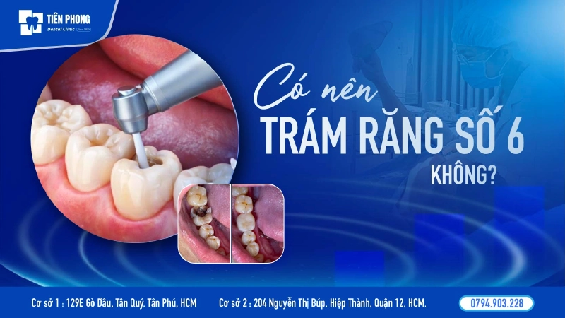 Trám răng số 6 – Giải pháp bảo tồn răng ăn nhai quan trọng nhất