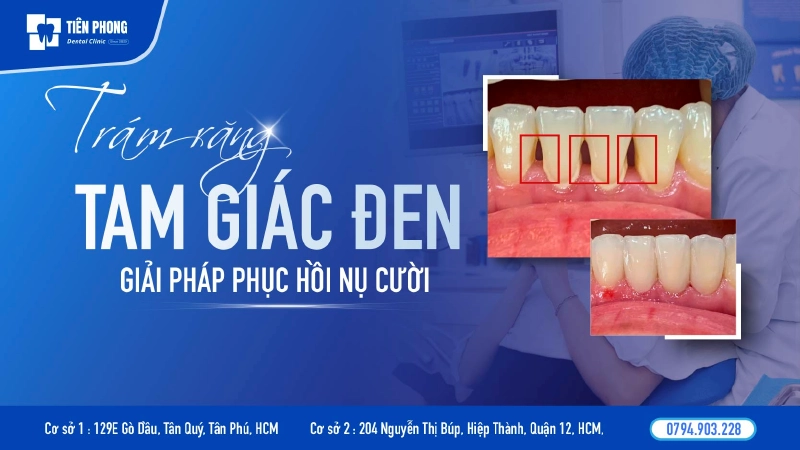 Trám răng tam giác đen – Giải pháp khắc phục kẽ hở nụ cười hiệu quả