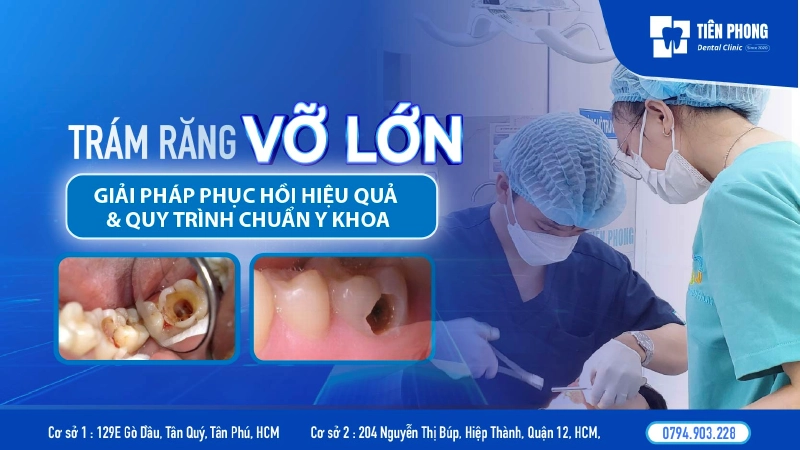 Trám răng vỡ lớn có được không? Giải pháp phục hồi hiệu quả và quy trình chuẩn