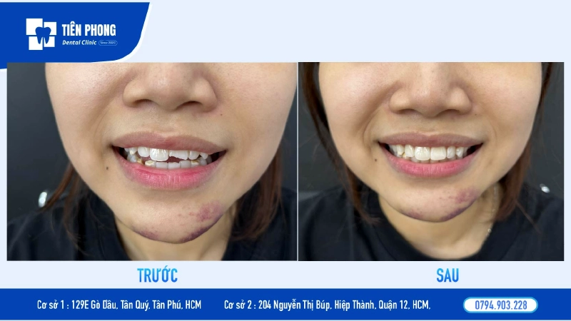 trước sau trám răng gãy trước sau trám răng gãy
