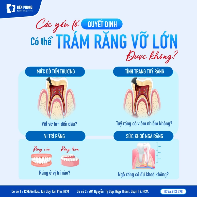 Các yếu tố quyết định có thể trám răng vỡ lớn được hay không? Các yếu tố quyết định có thể trám răng vỡ lớn được hay không?