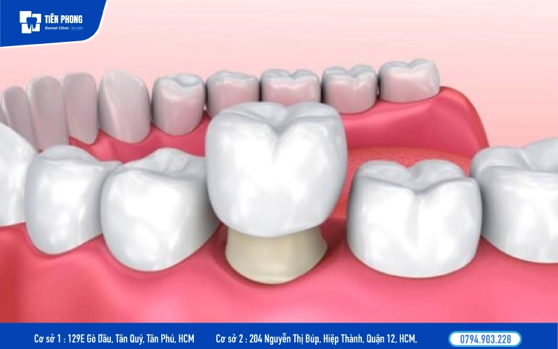Bọc răng sứ là kỹ thuật phục hình răng chuyên sâu hơn Bọc răng sứ là kỹ thuật phục hình răng chuyên sâu hơn