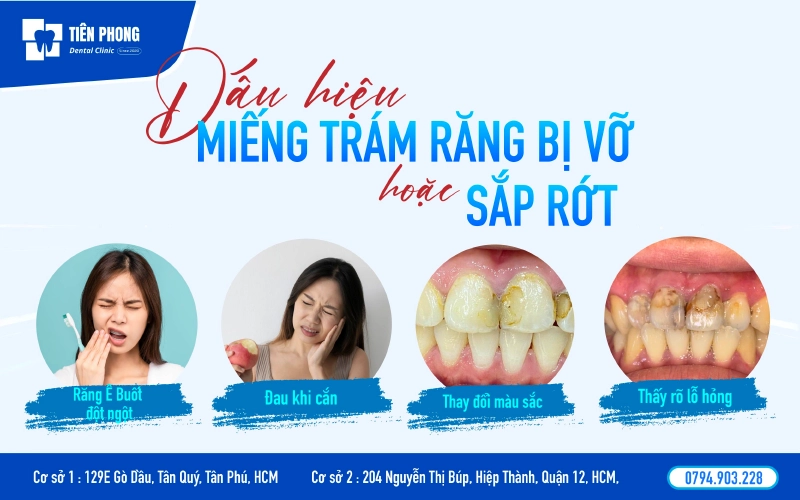 Dấu hiệu miếng trám răng bị vỡ hoặc sắp rớt Dấu hiệu miếng trám răng bị vỡ hoặc sắp rớt
