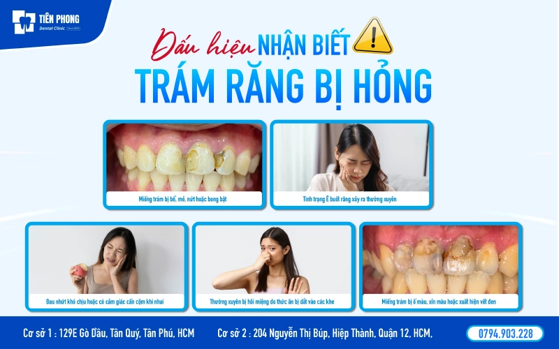 Dấu hiệu nhận biết trám răng bị hòng