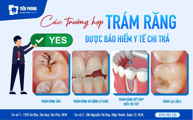 Các trường hợp trám răng được bảo hiểm y tế chi trả Các trường hợp trám răng được bảo hiểm y tế chi trả